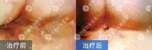 泉州看肛瘘哪家医院好